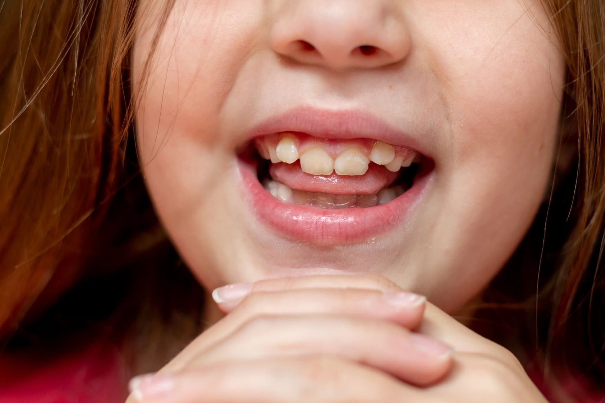 八重歯の子どもの口元